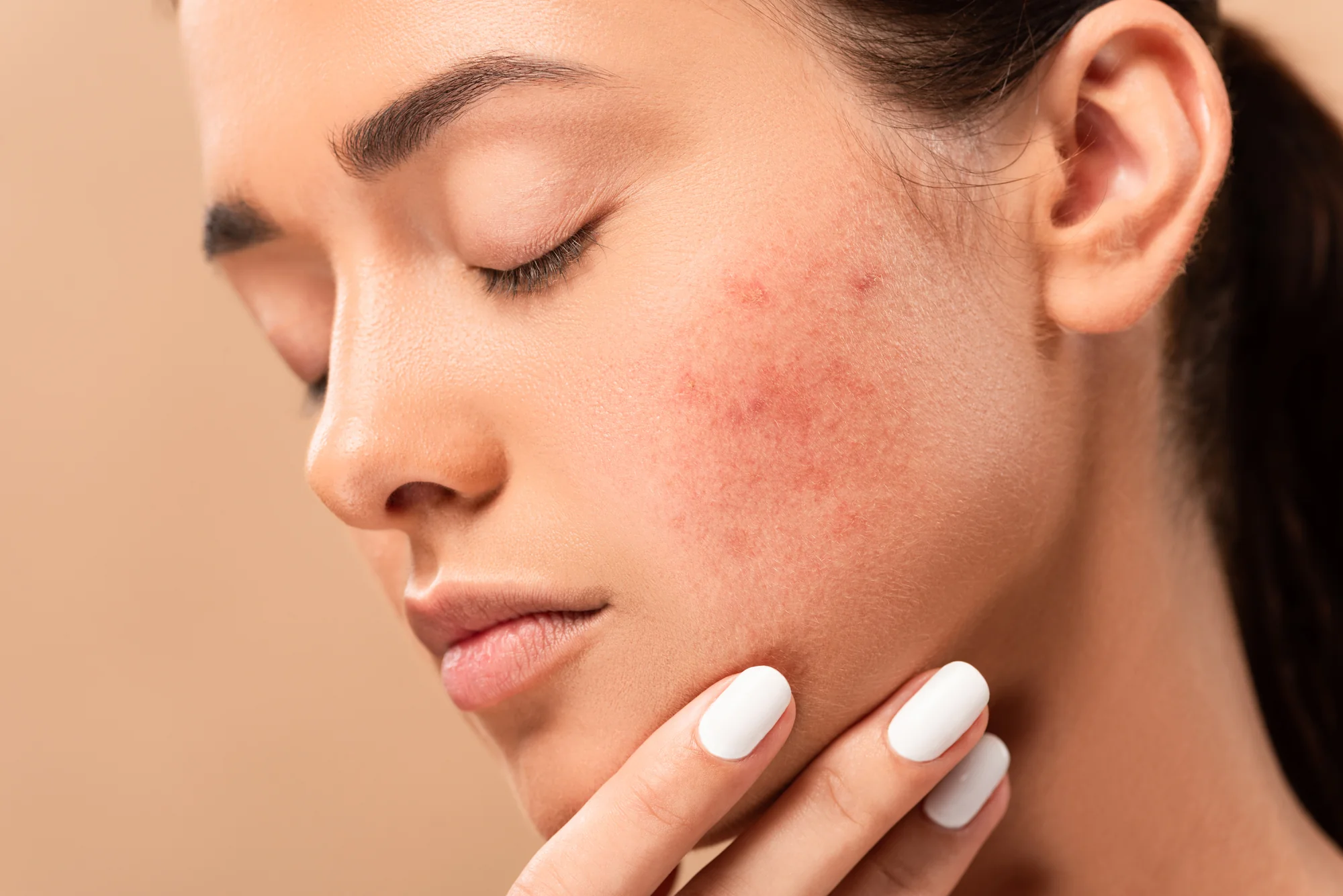 Best Korean Skincare for Acne Scars